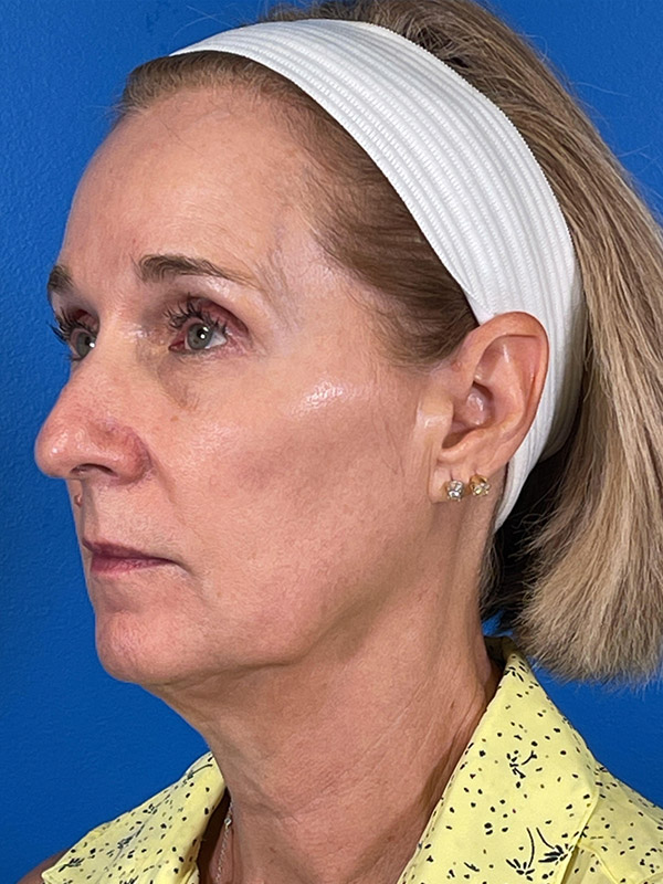 Facelift Before and After | Plastic Surgery Associates of Valdosta