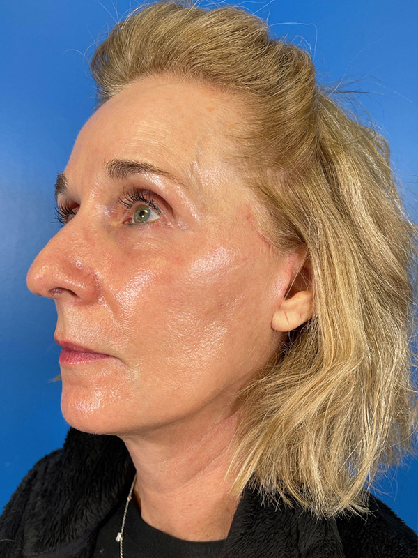 Facelift Before and After | Plastic Surgery Associates of Valdosta