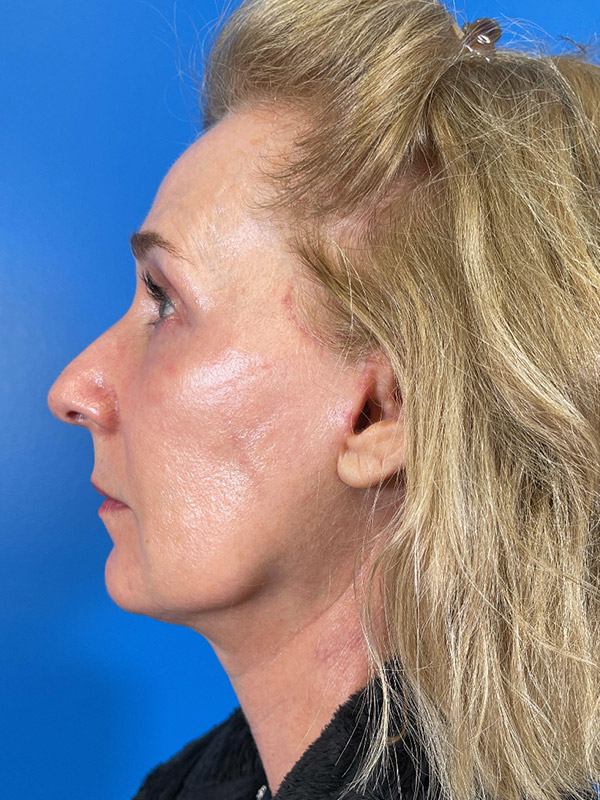 Facelift Before and After | Plastic Surgery Associates of Valdosta