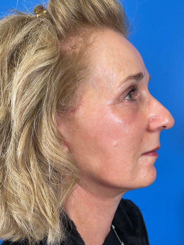 Facelift Before and After | Plastic Surgery Associates of Valdosta