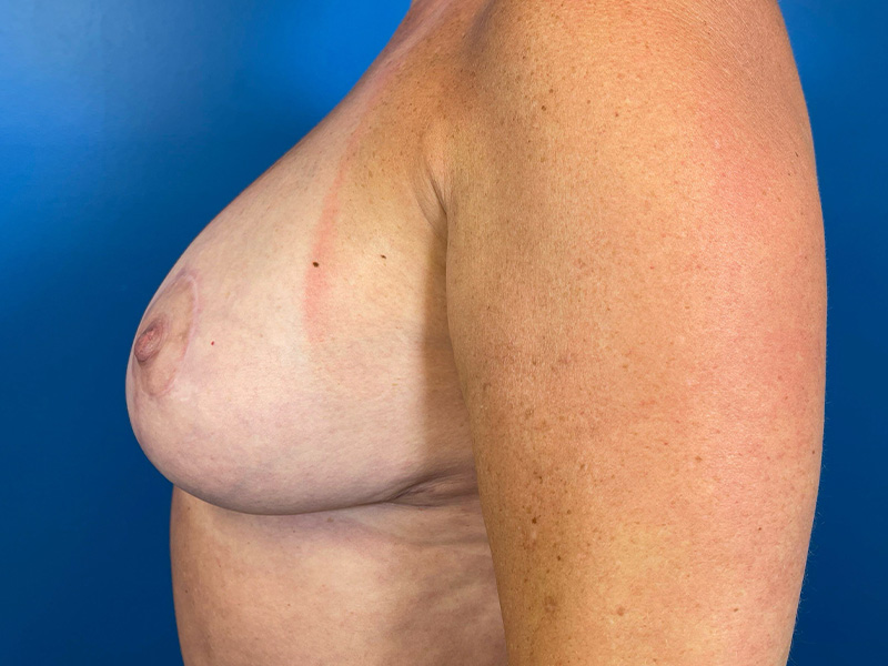 Fat Grafting Before and After | Plastic Surgery Associates of Valdosta