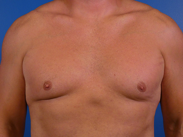 Gynecomastia Before and After | Plastic Surgery Associates of Valdosta