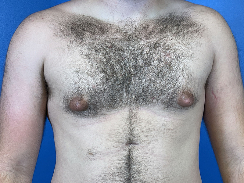 Gynecomastia Before and After | Plastic Surgery Associates of Valdosta