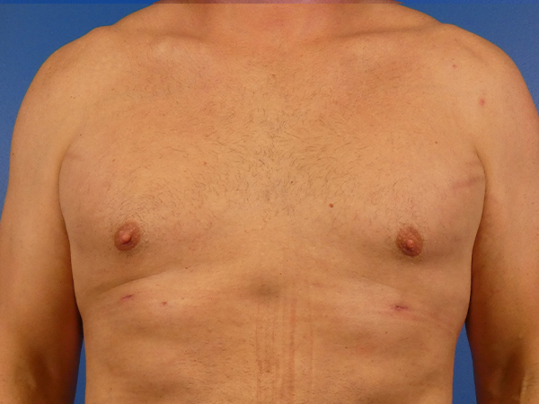 Gynecomastia Before and After | Plastic Surgery Associates of Valdosta