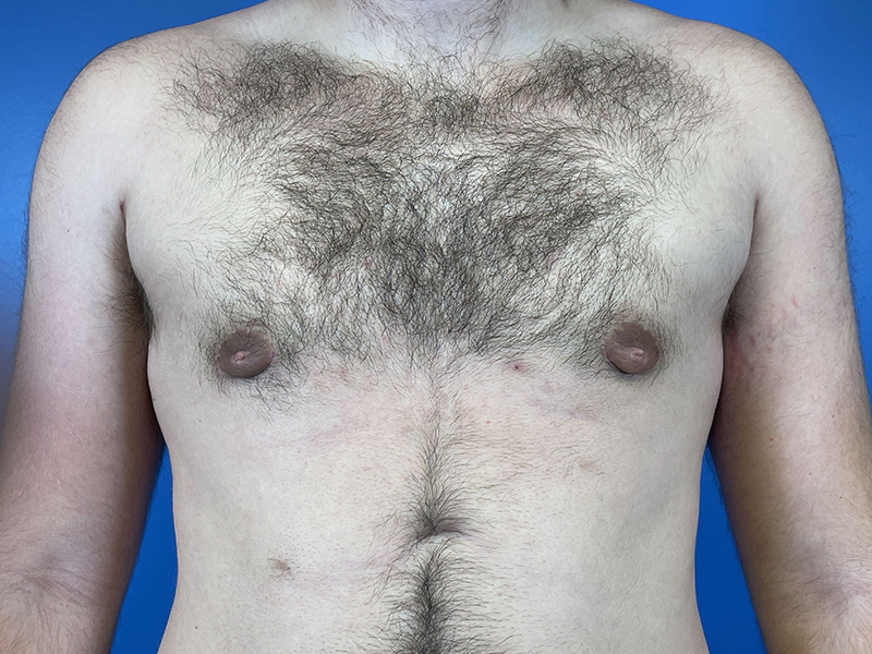 Gynecomastia Before and After | Plastic Surgery Associates of Valdosta