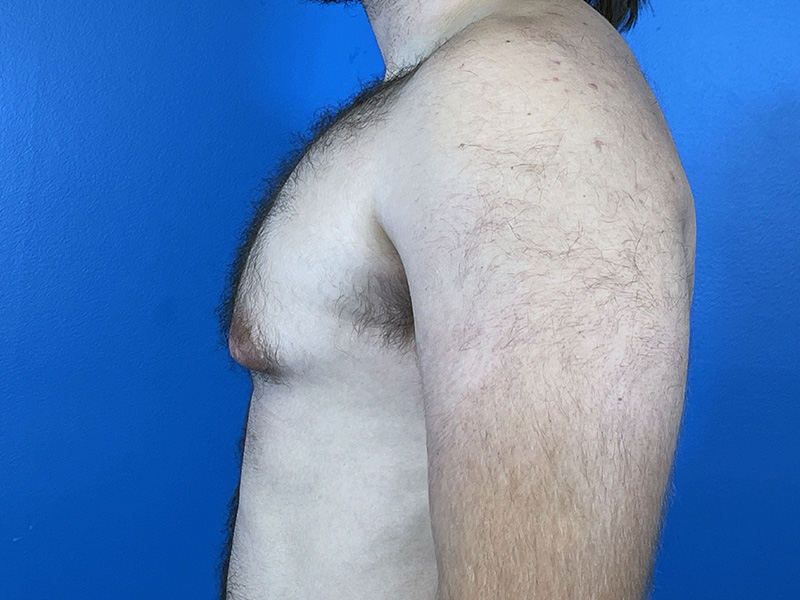 Gynecomastia Before and After | Plastic Surgery Associates of Valdosta