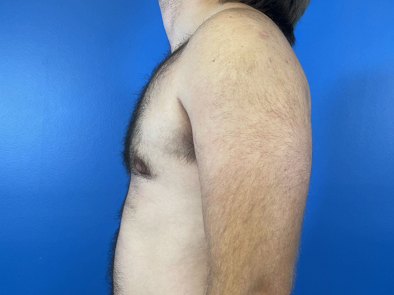 Gynecomastia Before and After | Plastic Surgery Associates of Valdosta