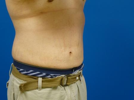 Gynecomastia Before and After | Plastic Surgery Associates of Valdosta