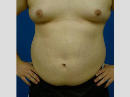Gynecomastia Before and After | Plastic Surgery Associates of Valdosta