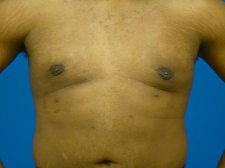 Gynecomastia Before and After | Plastic Surgery Associates of Valdosta