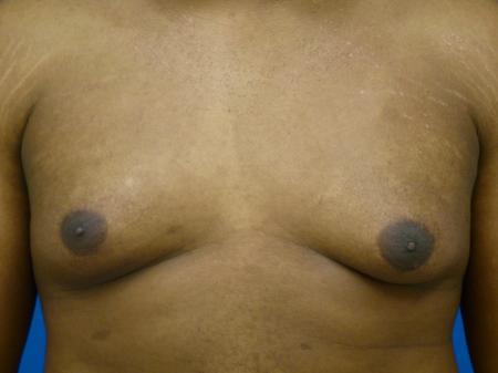 Gynecomastia Before and After | Plastic Surgery Associates of Valdosta