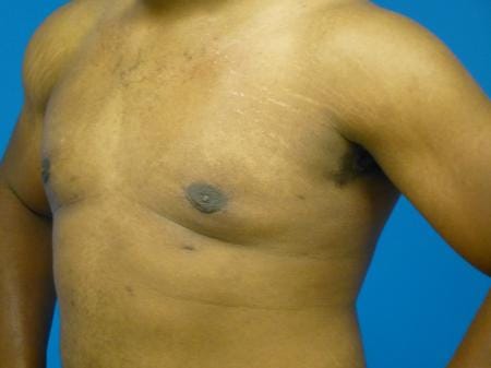 Gynecomastia Before and After | Plastic Surgery Associates of Valdosta