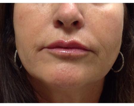 Injectables Face Before and After | Plastic Surgery Associates of Valdosta