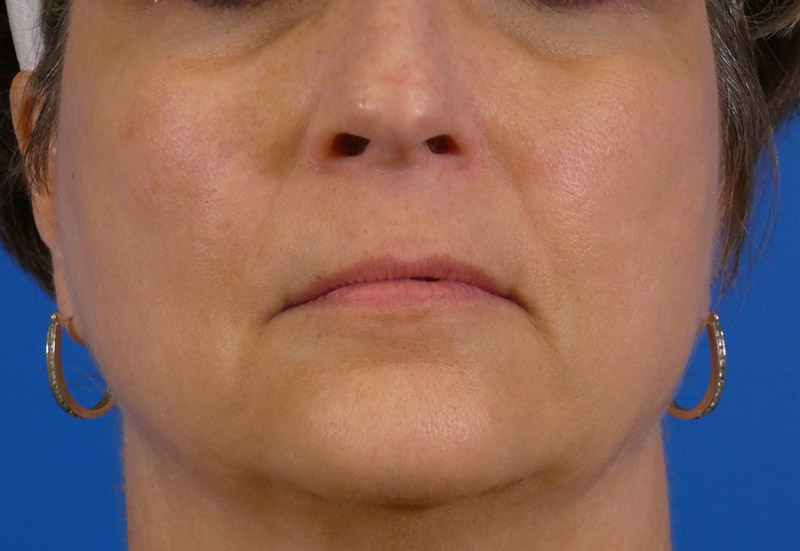 Injectables Face Before and After | Plastic Surgery Associates of Valdosta