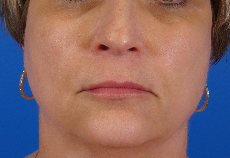 Injectables Face Before and After | Plastic Surgery Associates of Valdosta