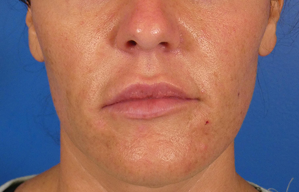 Injectables Face Before and After | Plastic Surgery Associates of Valdosta