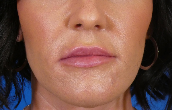 Injectables Face Before and After | Plastic Surgery Associates of Valdosta