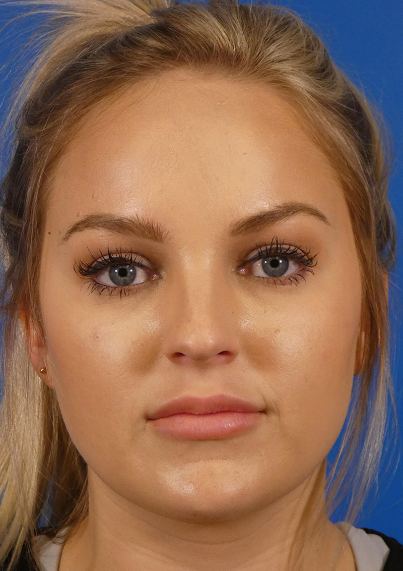 Injectables Face Before and After | Plastic Surgery Associates of Valdosta