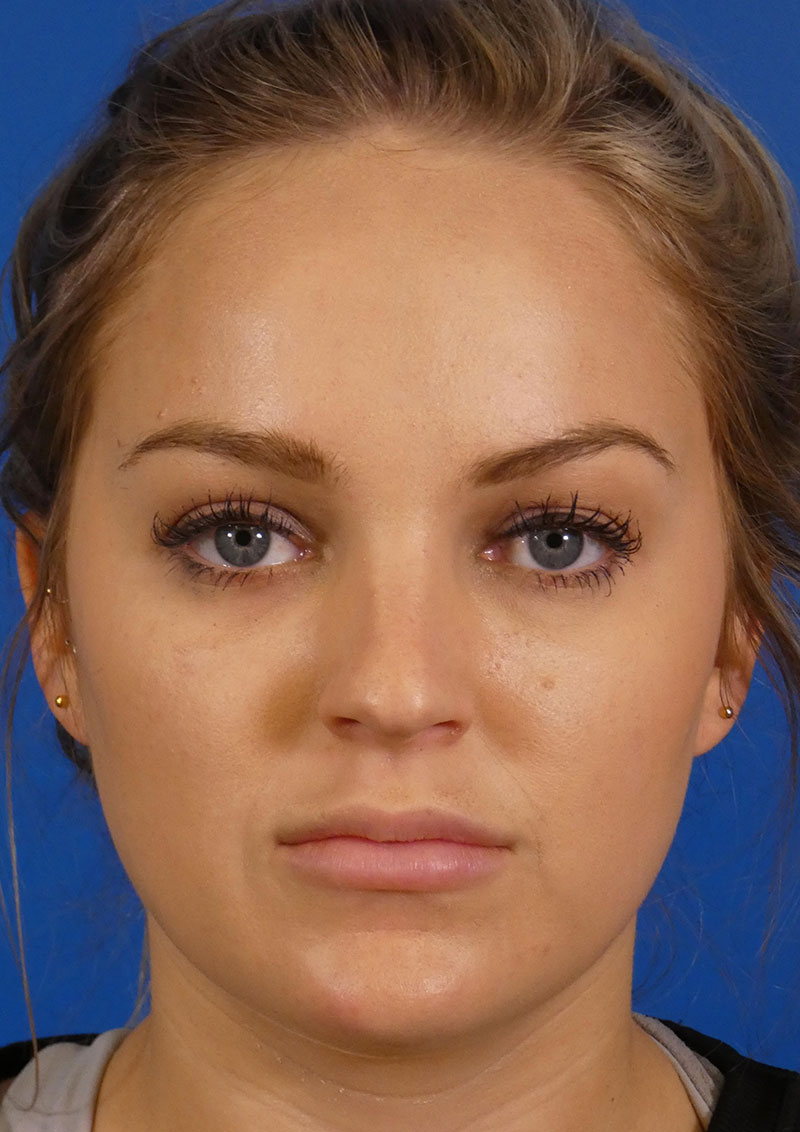 Injectables Face Before and After | Plastic Surgery Associates of Valdosta