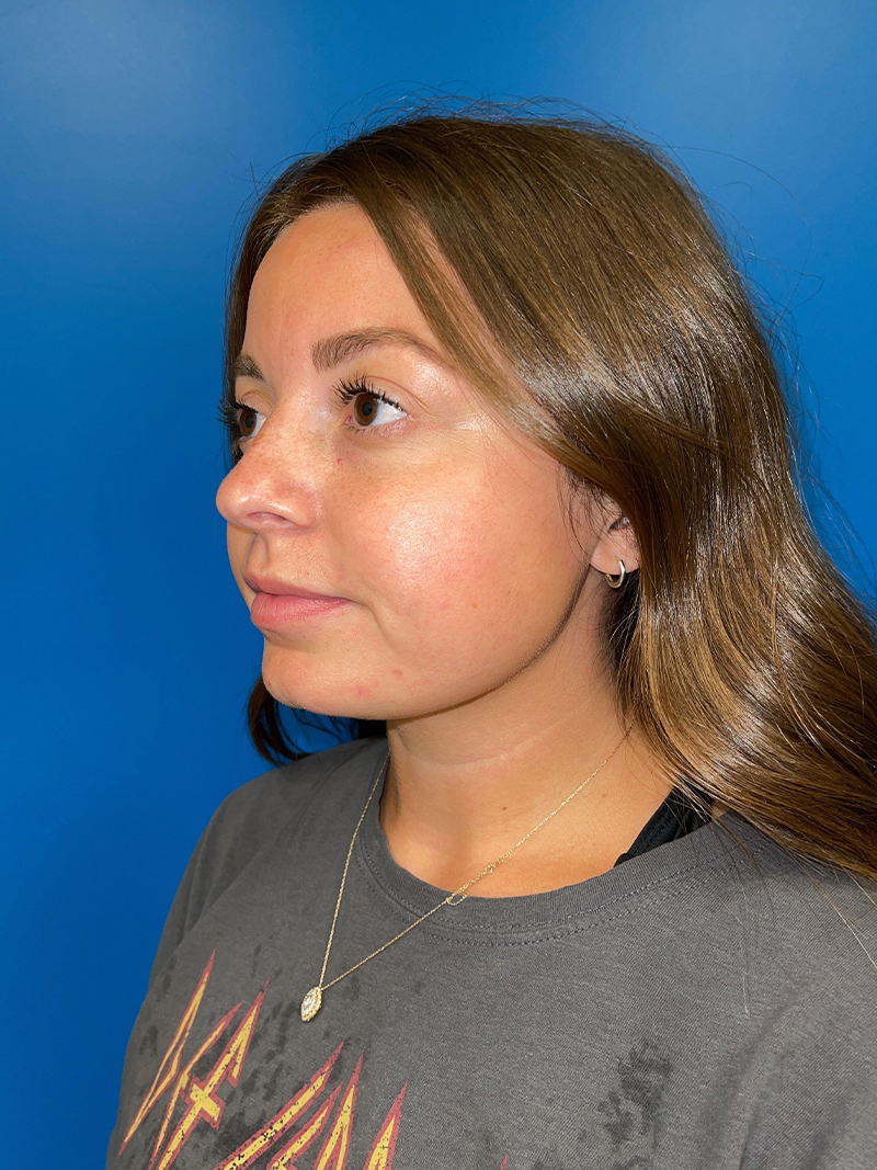 Injectables Face Before and After | Plastic Surgery Associates of Valdosta