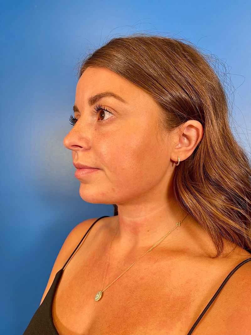 Injectables Face Before and After | Plastic Surgery Associates of Valdosta