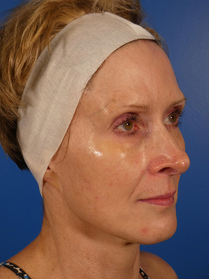 Ipl Sun Spots Before and After | Plastic Surgery Associates of Valdosta