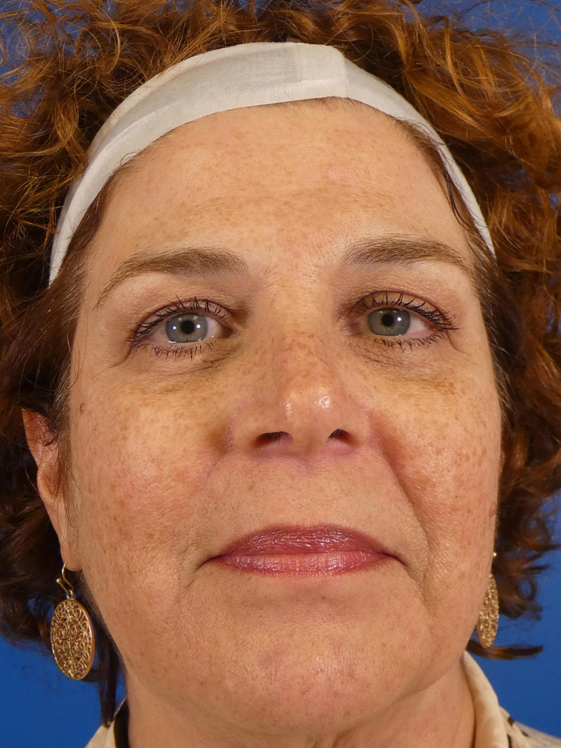 Ipl Sun Spots Before and After | Plastic Surgery Associates of Valdosta