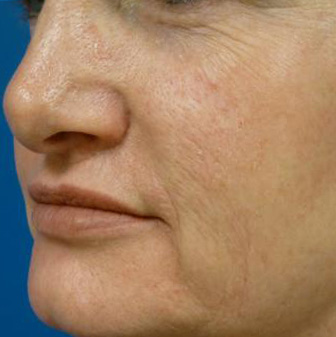 Laser Skin Resurfacing Before and After | Plastic Surgery Associates of Valdosta