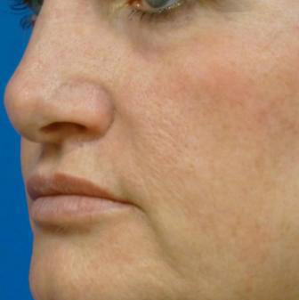 Laser Skin Resurfacing Before and After | Plastic Surgery Associates of Valdosta