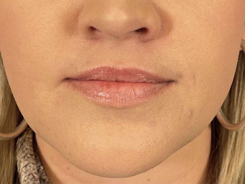 Lip Filler Before and After | Plastic Surgery Associates of Valdosta