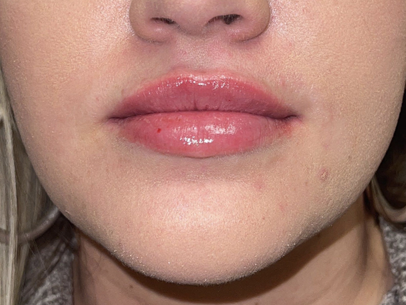 Lip Filler Before and After | Plastic Surgery Associates of Valdosta