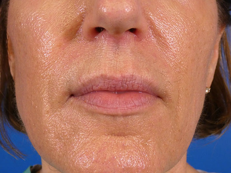 Lip Filler Before and After | Plastic Surgery Associates of Valdosta