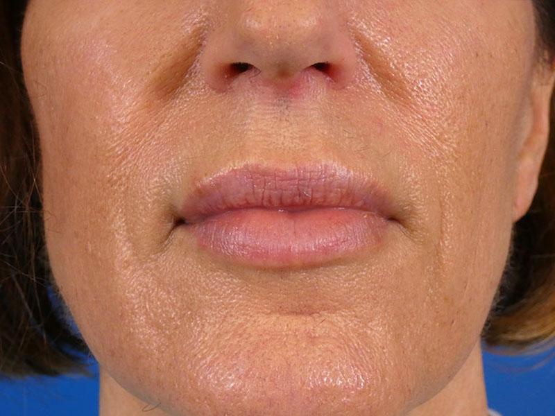 Lip Filler Before and After | Plastic Surgery Associates of Valdosta