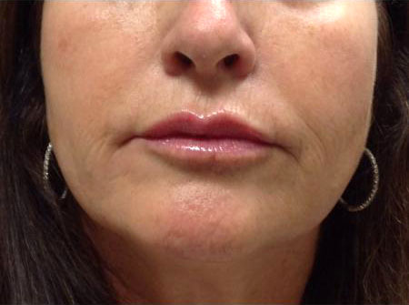 Lip Filler Before and After | Plastic Surgery Associates of Valdosta