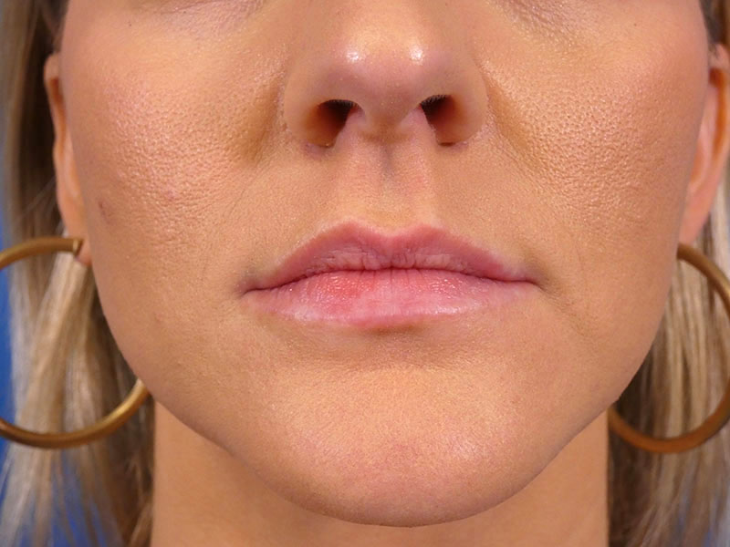 Lip Filler Before and After | Plastic Surgery Associates of Valdosta