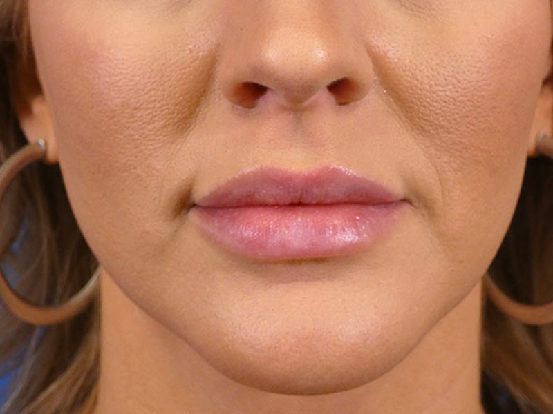 Lip Filler Before and After | Plastic Surgery Associates of Valdosta