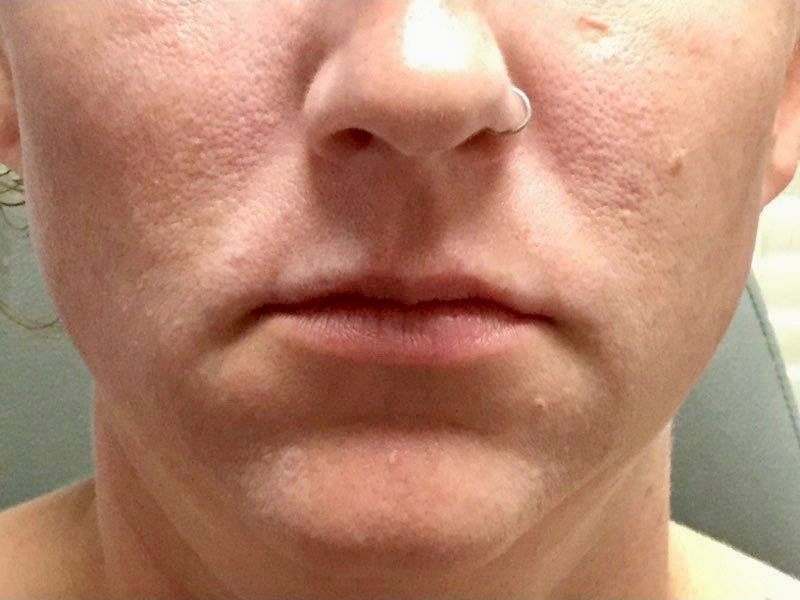 Lip Filler Before and After | Plastic Surgery Associates of Valdosta