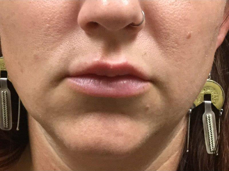 Lip Filler Before and After | Plastic Surgery Associates of Valdosta