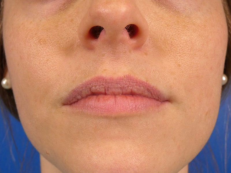 Lip Filler Before and After | Plastic Surgery Associates of Valdosta