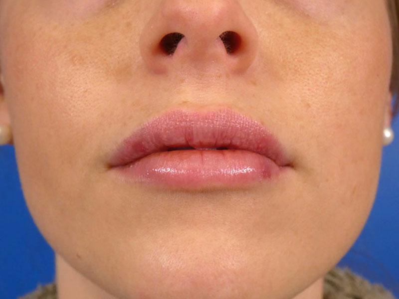 Lip Filler Before and After | Plastic Surgery Associates of Valdosta