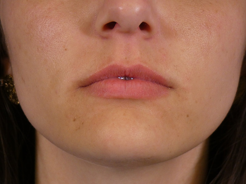 Lip Filler Before and After | Plastic Surgery Associates of Valdosta