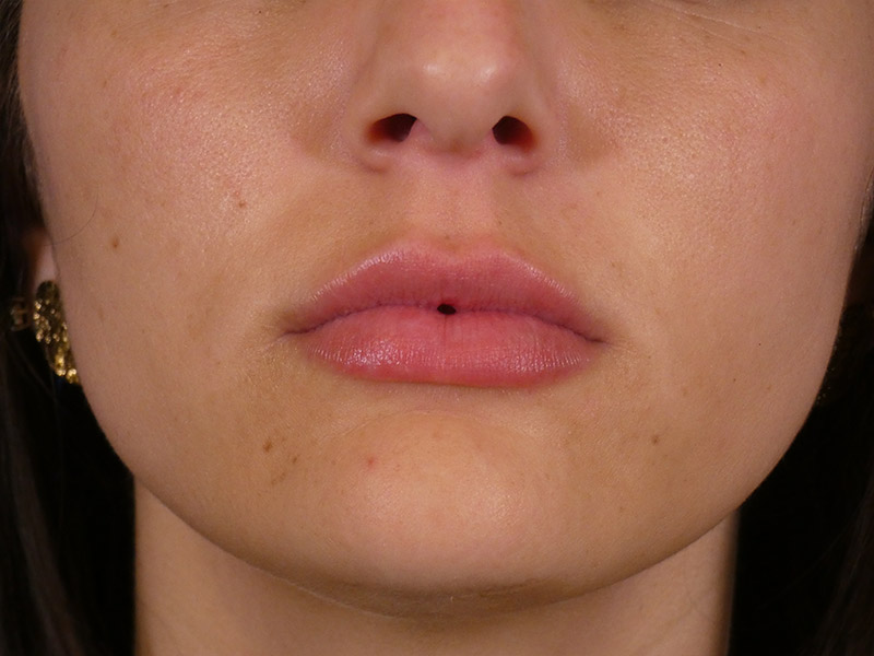 Lip Filler Before and After | Plastic Surgery Associates of Valdosta