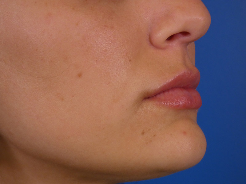 Lip Filler Before and After | Plastic Surgery Associates of Valdosta