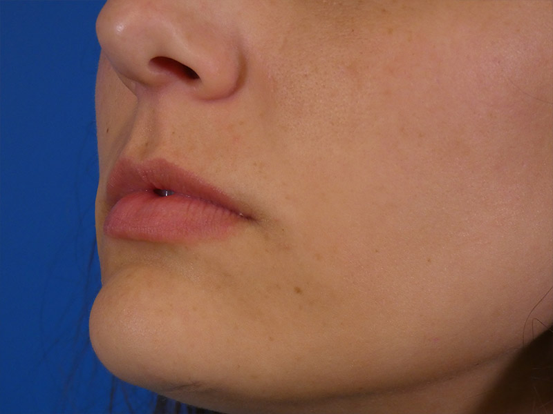 Lip Filler Before and After | Plastic Surgery Associates of Valdosta