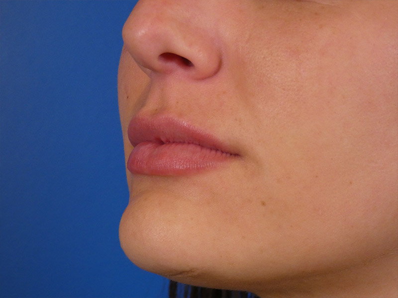 Lip Filler Before and After | Plastic Surgery Associates of Valdosta