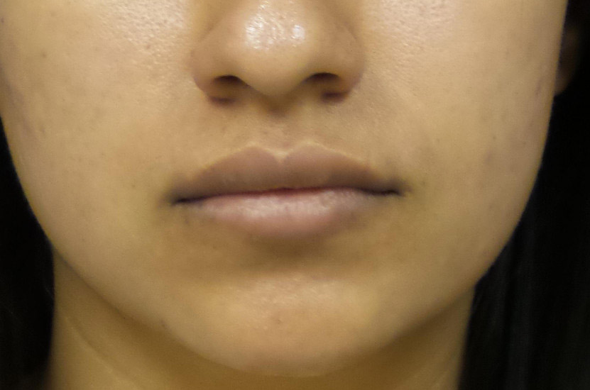 Lip Filler Before and After | Plastic Surgery Associates of Valdosta