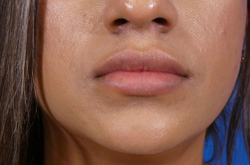 Lip Filler Before and After | Plastic Surgery Associates of Valdosta