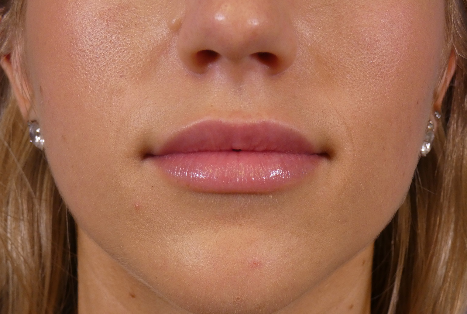 Lip Filler Before and After | Plastic Surgery Associates of Valdosta