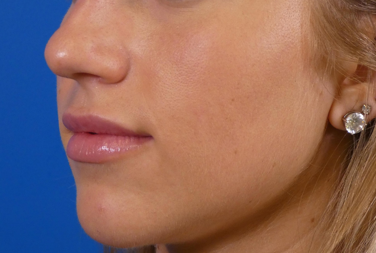 Lip Filler Before and After | Plastic Surgery Associates of Valdosta