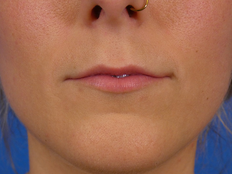 Lip Filler Before and After | Plastic Surgery Associates of Valdosta